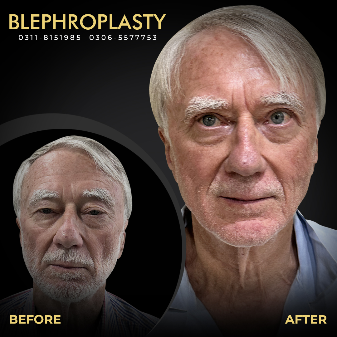 Blephroplasty Web Banner 01