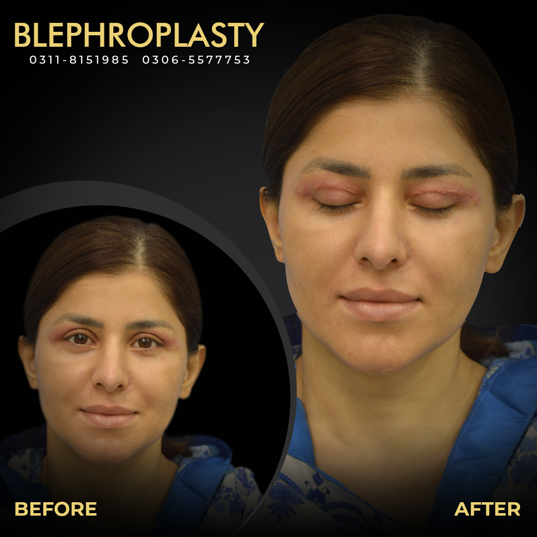 Blephroplasty Web Banner 02