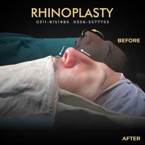 Rhinoplasty Web Banner 01