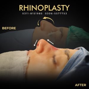 Rhinoplasty Web Banner 02