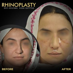 Rhinoplasty Web Banner 03