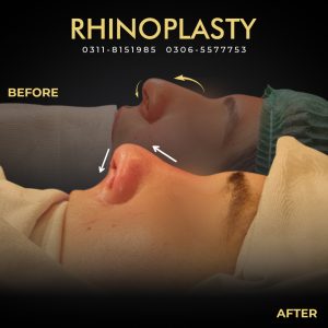 Rhinoplasty Web Banner 04