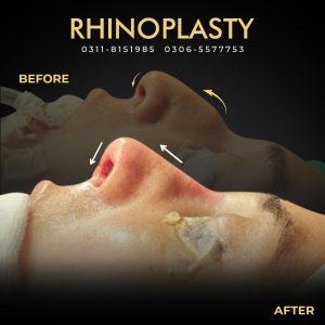 Rhinoplasty Web Banner 05