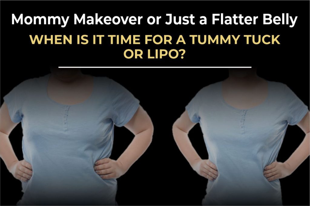 Mommy Makeover, Tummy Tuck
